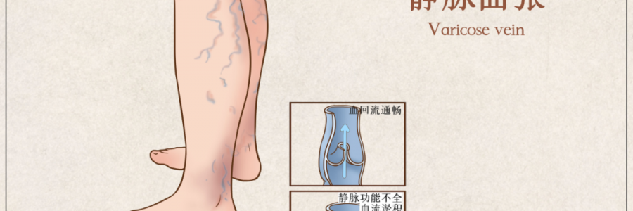 告別“蚯蚓腿”，靜脈曲張怎么調(diào)？