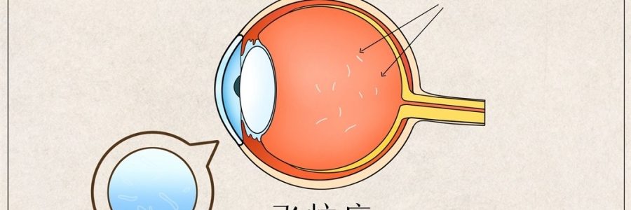 “蚊子”在眼里飛？這類人要注意了！