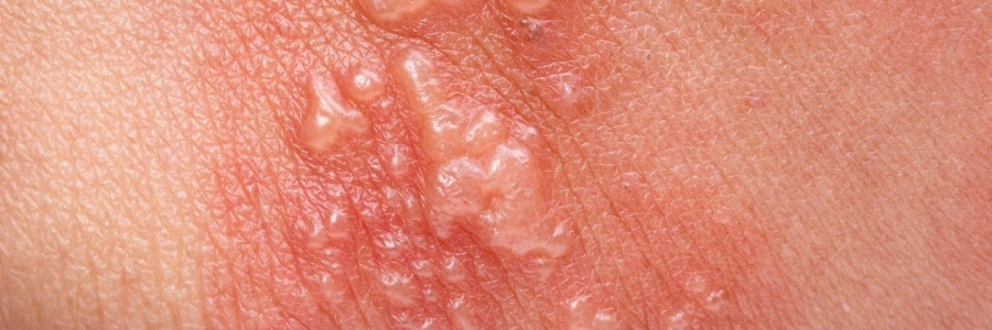 艾灸后起了小水泡，居然是邪氣在“逃跑”！