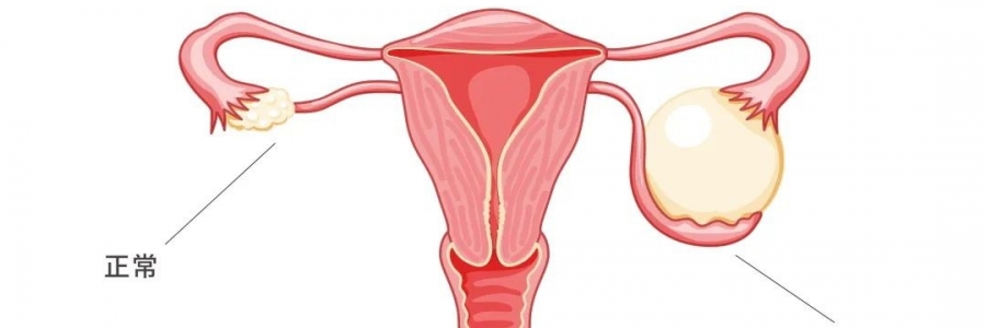 太神奇了，艾灸調(diào)好了她的卵巢囊腫！
